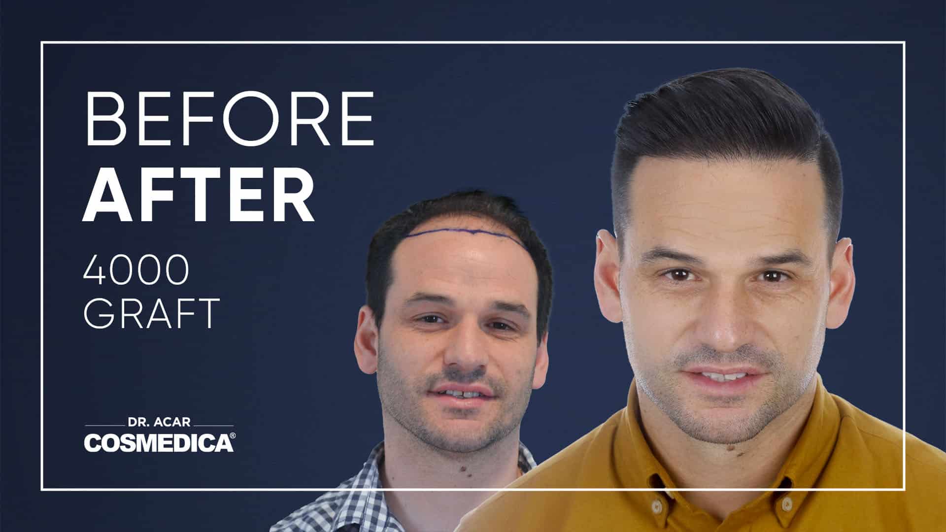 Hair Transplant in Turkey | Hair Transplant Results 4000 grafts of Cosmedica