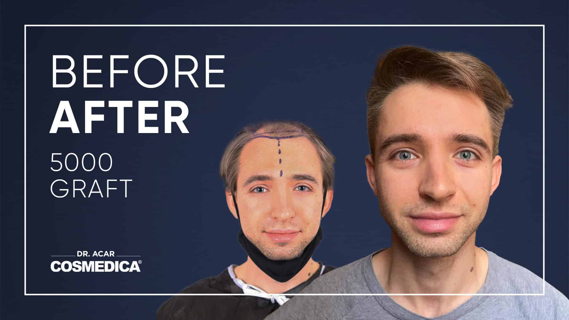 Hair Transplant in Turkey | Hair Transplant Results of Cosmedica