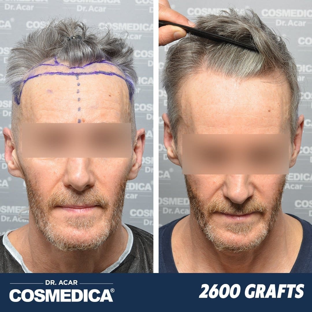 Hair Transplant in Turkey with 2600 Grafts