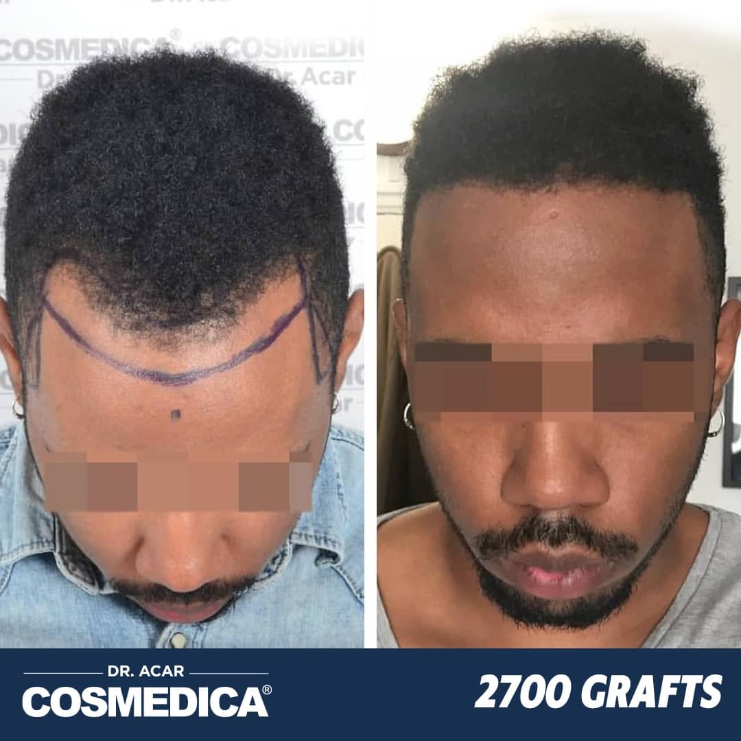 Hair Transplant in Turkey with 2700 Grafts