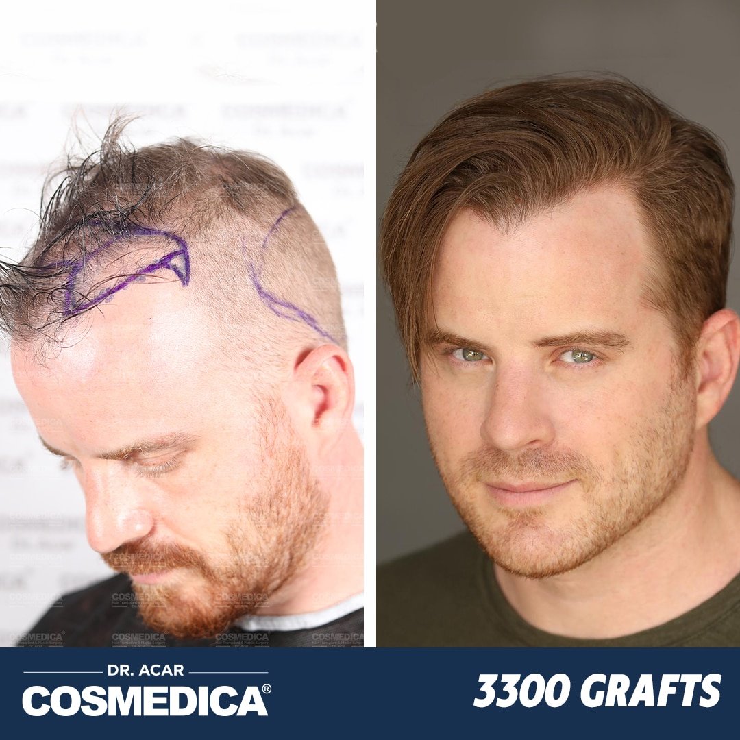 Hair Transplant in Turkey with 3300 Grafts