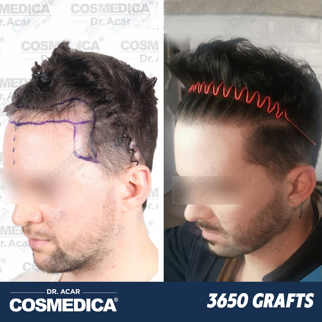 Hair Transplant in Turkey with 3650 Grafts