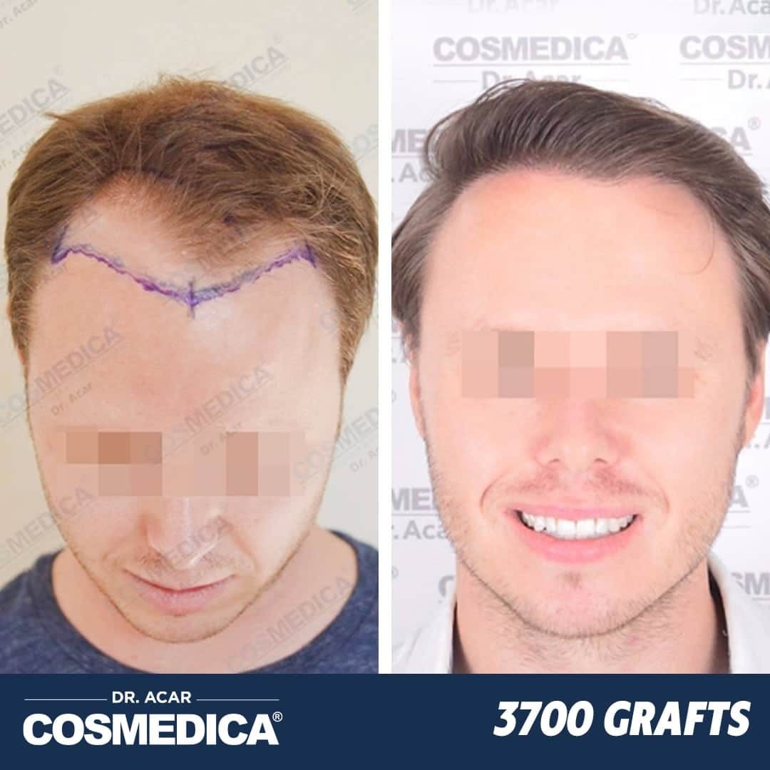 Hair Transplant in Turkey with 3700 Grafts