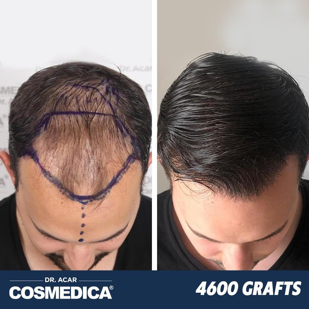 Hair Transplant in Turkey with 4600 Grafts