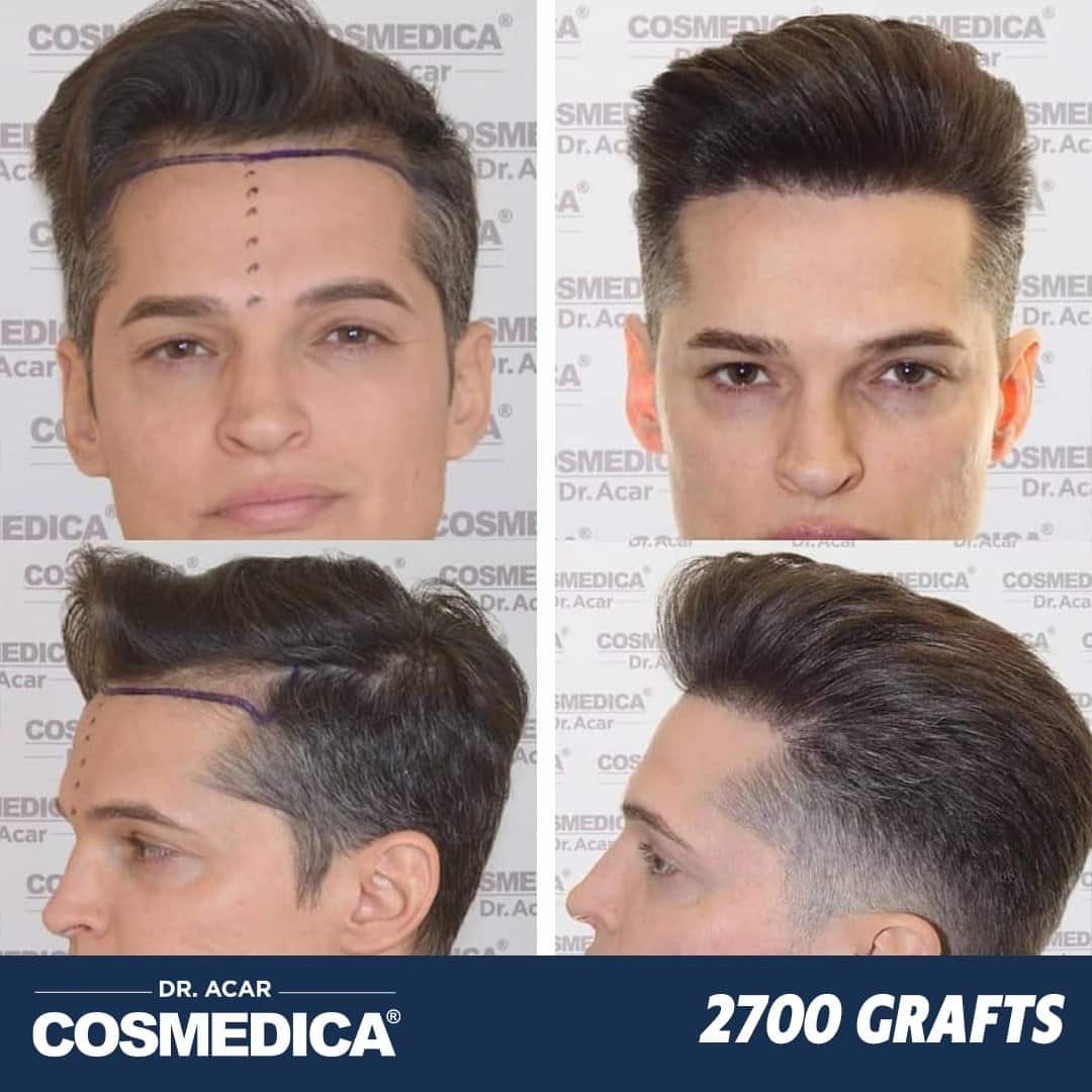 Hair Transplant in Turkey with 2700 Grafts