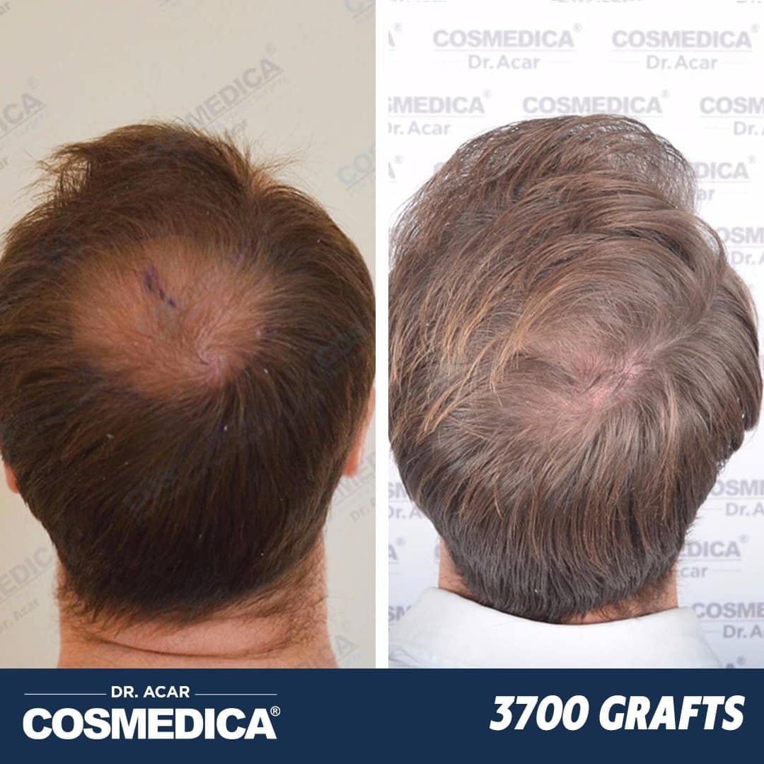 Hair Transplant in Turkey with 3700 Grafts